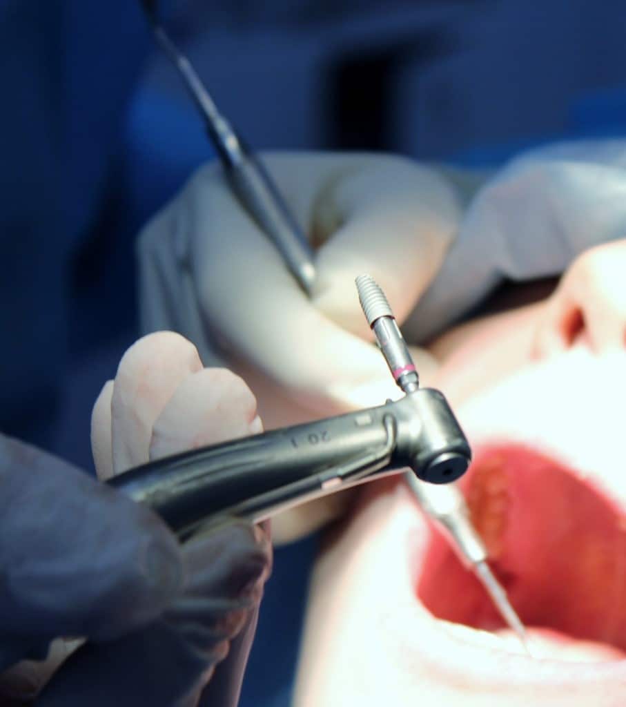 Имплантация зубов в Пензе