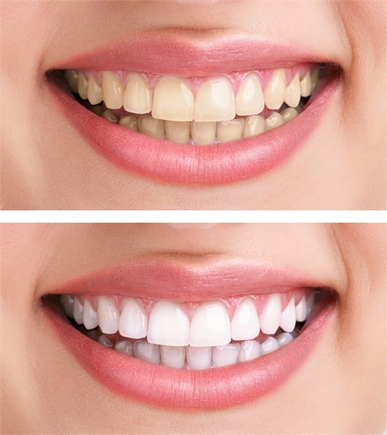 Эстетические свойства композитов в лечении зубов на современном этапе